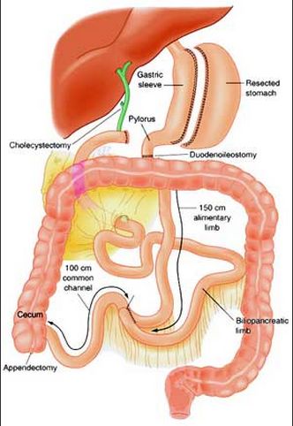 Obesity treatment